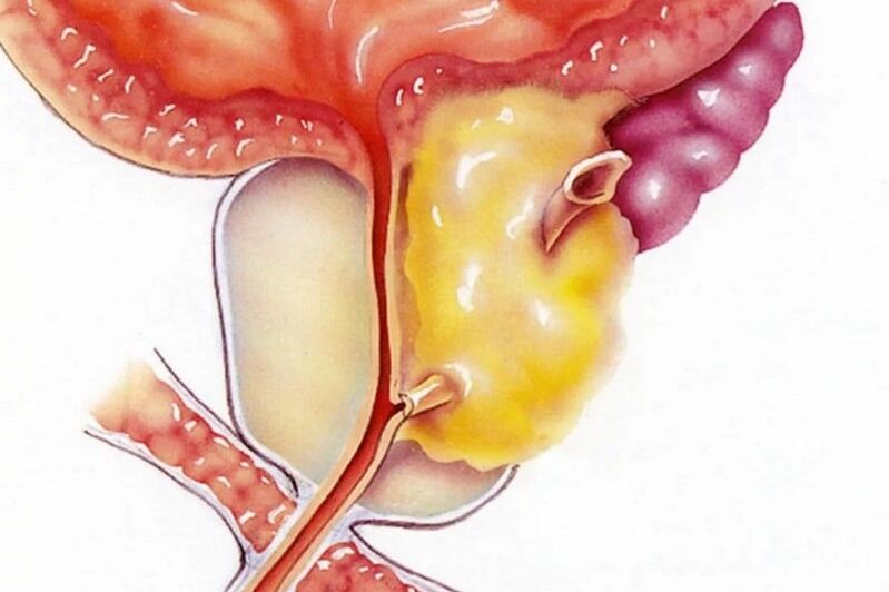 Entzündung vum Prostata